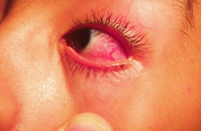 Los ojos inflamados y sin secreción so uno de los síntomas que permiten reconocer el síndrome de Kawasaki.