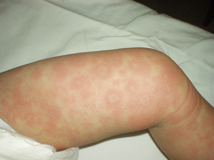 Este es el sarpullido característico de la enfermedad de Kawasaki. Aparece acompañado por inflamación en los ojos y en la boca, además de fiebre alta sostenida.