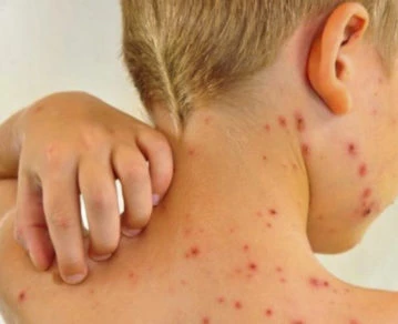 COVID-19 y sus comparaciones con el sarampión