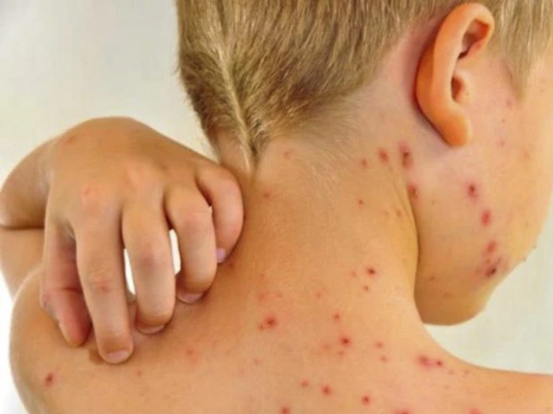 COVID-19 y sus comparaciones con el sarampión