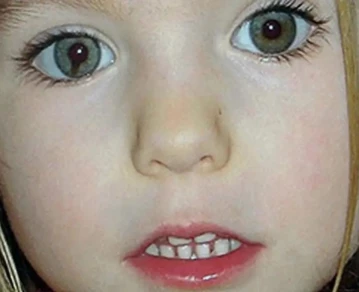 Coloboma: una mancha que aparece en el iris del ojo