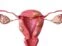 Una foto de cómo se presentan los miomas uterinos. 