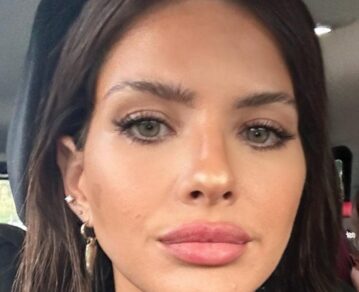 La China Suárez tuvo un accidente doméstico y se fracturó la nariz