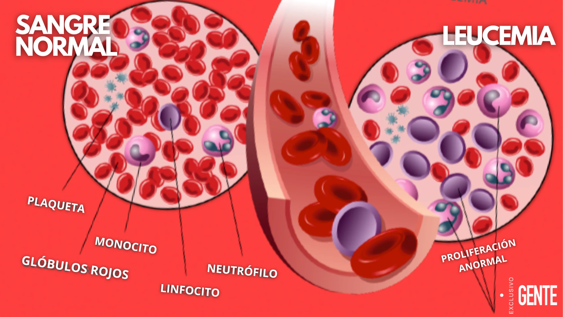 Así se comporta la sangre en un paciente sano y en uno que fue diagnosticado con leucemia. 