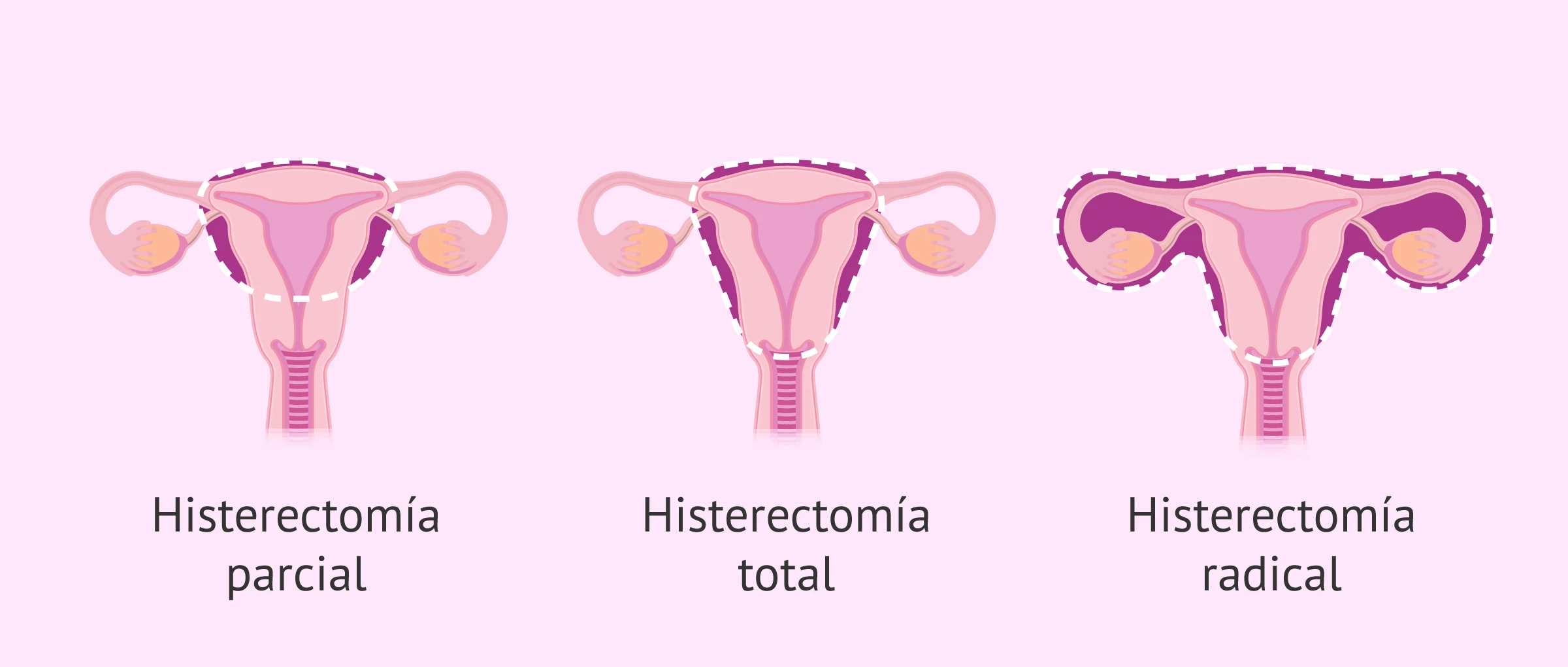 Estos son los tres procesos de histerectomía. 