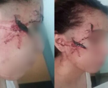 Horror en Santa Fe: una patota desfiguró a una adolescente de 15 años y su madre asegura que quisieron matarla